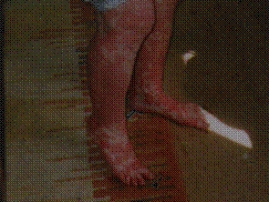 leg rash